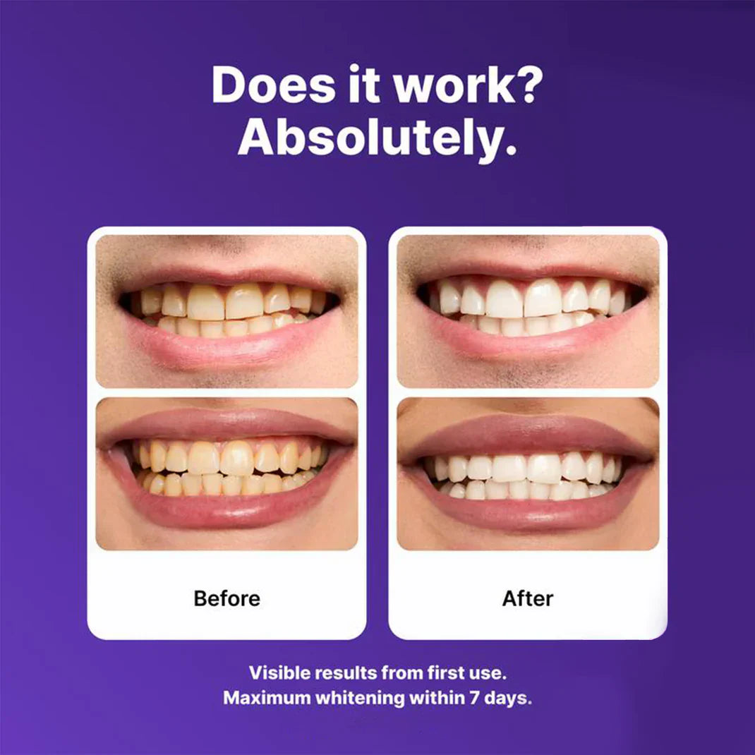 Purple Teeth Whitening Strips | Fast, Gentle & Peroxide-Free Whitening