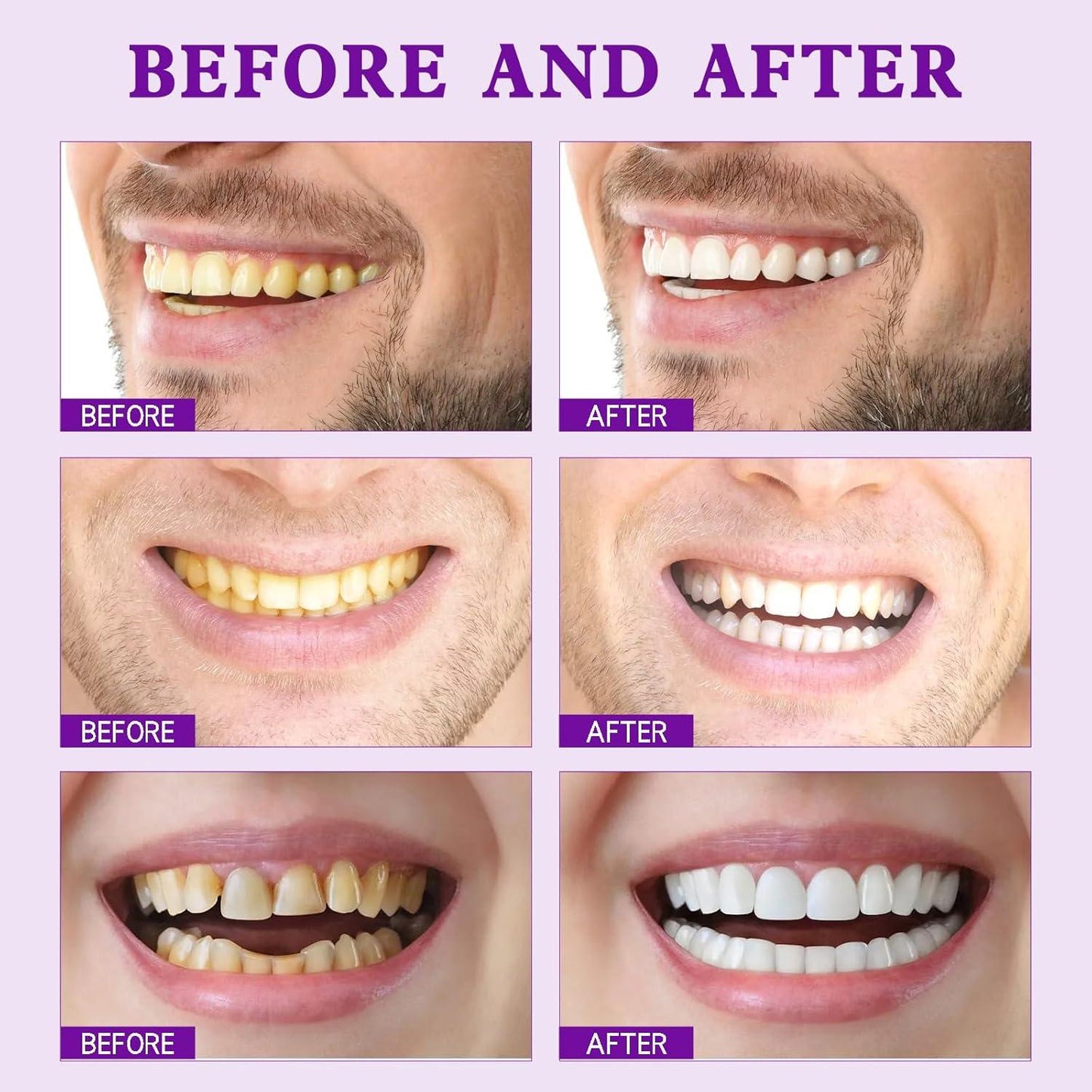 Purple Teeth Whitening Strips | Fast, Gentle & Peroxide-Free Whitening