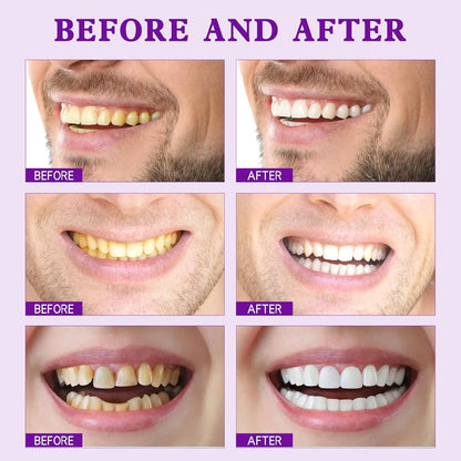 Purple Teeth Whitening Strips | Fast, Gentle & Peroxide-Free Whitening
