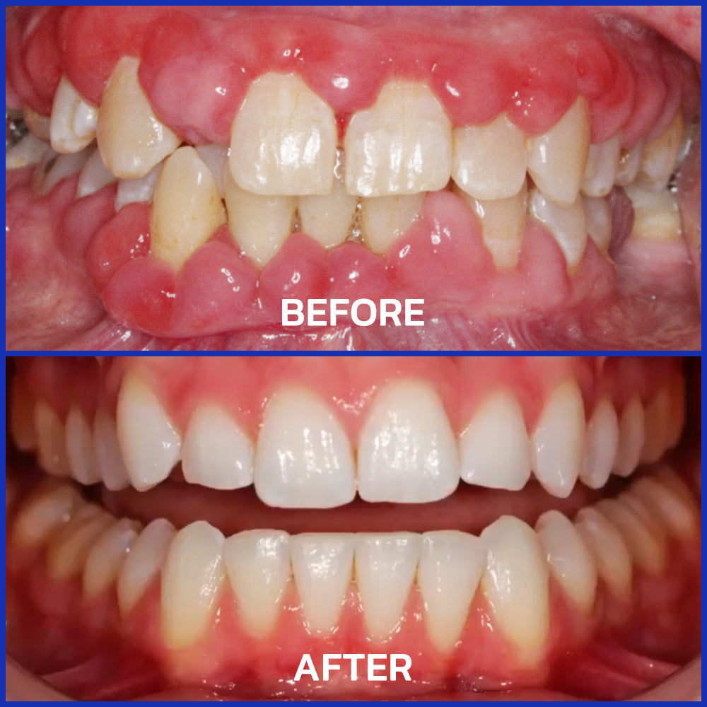 SmileFitPro  Dental Treatment Toothpaste Whiter Teeth Without Sensitivity
