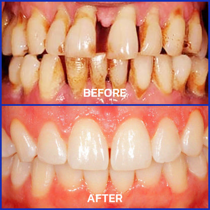 SmileFitPro  Dental Treatment Toothpaste Whiter Teeth Without Sensitivity