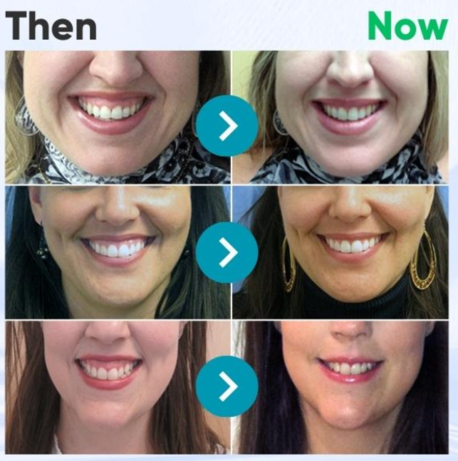 SmileFitPro  Dental Treatment Toothpaste Whiter Teeth Without Sensitivity